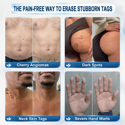 𝐏i𝐜𝐝o® 7-𝐷𝑎𝑦 𝗧𝐚𝐠 & 𝗦𝗽𝐨𝐭 𝐄𝐫𝒂𝒔𝒆𝒓(Zero Pain, Zero 𝐒𝐜𝐚𝒓𝒔 Rollerball)