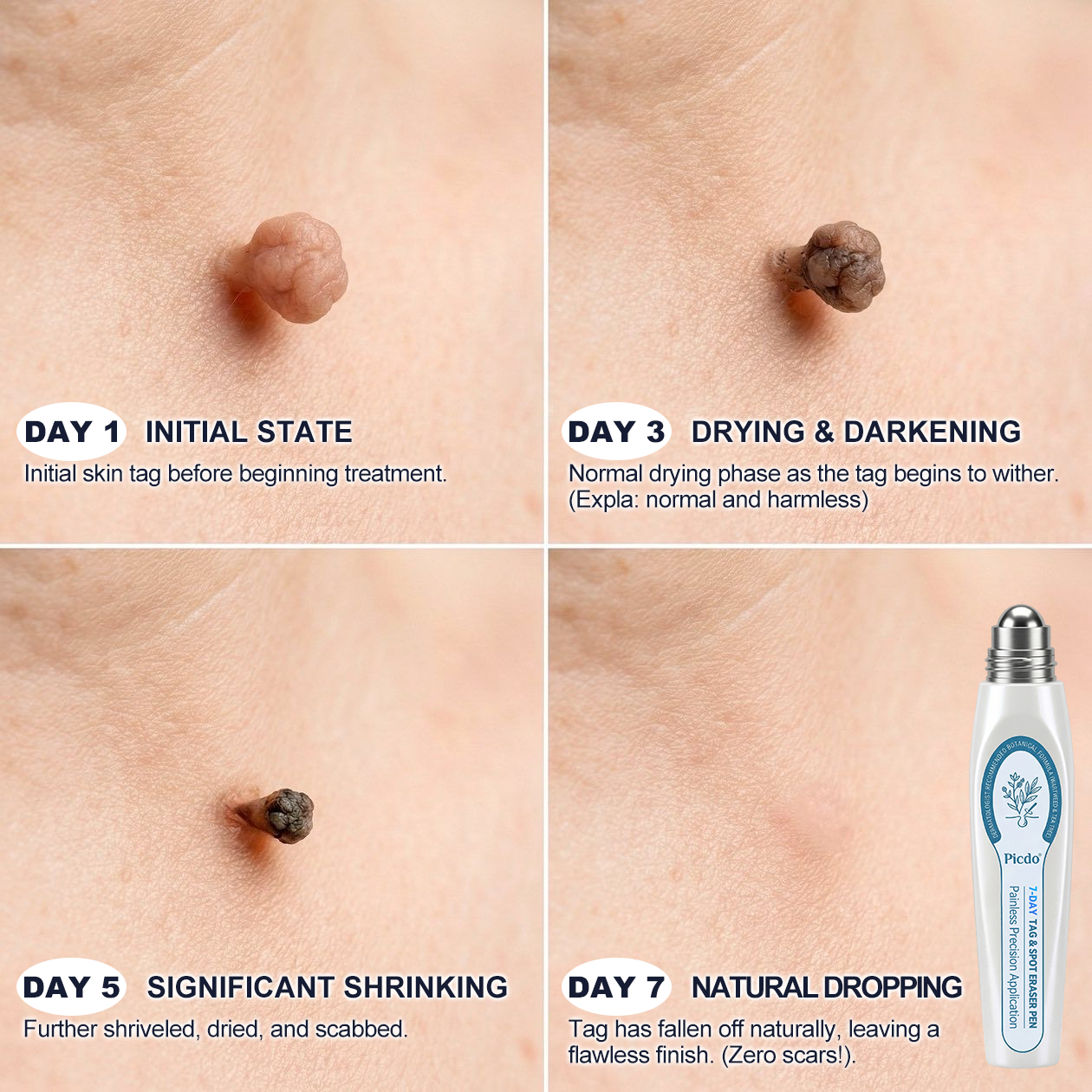𝐏i𝐜𝐝o® 7-𝐷𝑎𝑦 𝗧𝐚𝐠 & 𝗦𝗽𝐨𝐭 𝐄𝐫𝒂𝒔𝒆𝒓(Zero Pain, Zero 𝐒𝐜𝐚𝒓𝒔 Rollerball)