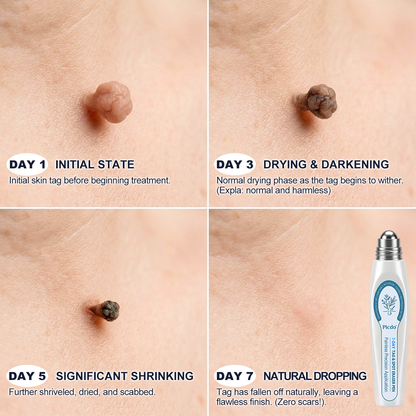 𝐏i𝐜𝐝o® 7-𝐷𝑎𝑦 𝗧𝐚𝐠 & 𝗦𝗽𝐨𝐭 𝐄𝐫𝒂𝒔𝒆𝒓(Zero Pain, Zero 𝐒𝐜𝐚𝒓𝒔 Rollerball)